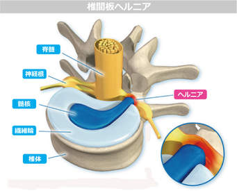 椎間板ヘルニア　画像